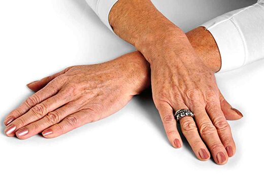 With age-related changes in the skin of the hand, it requires the use of rejuvenation techniques