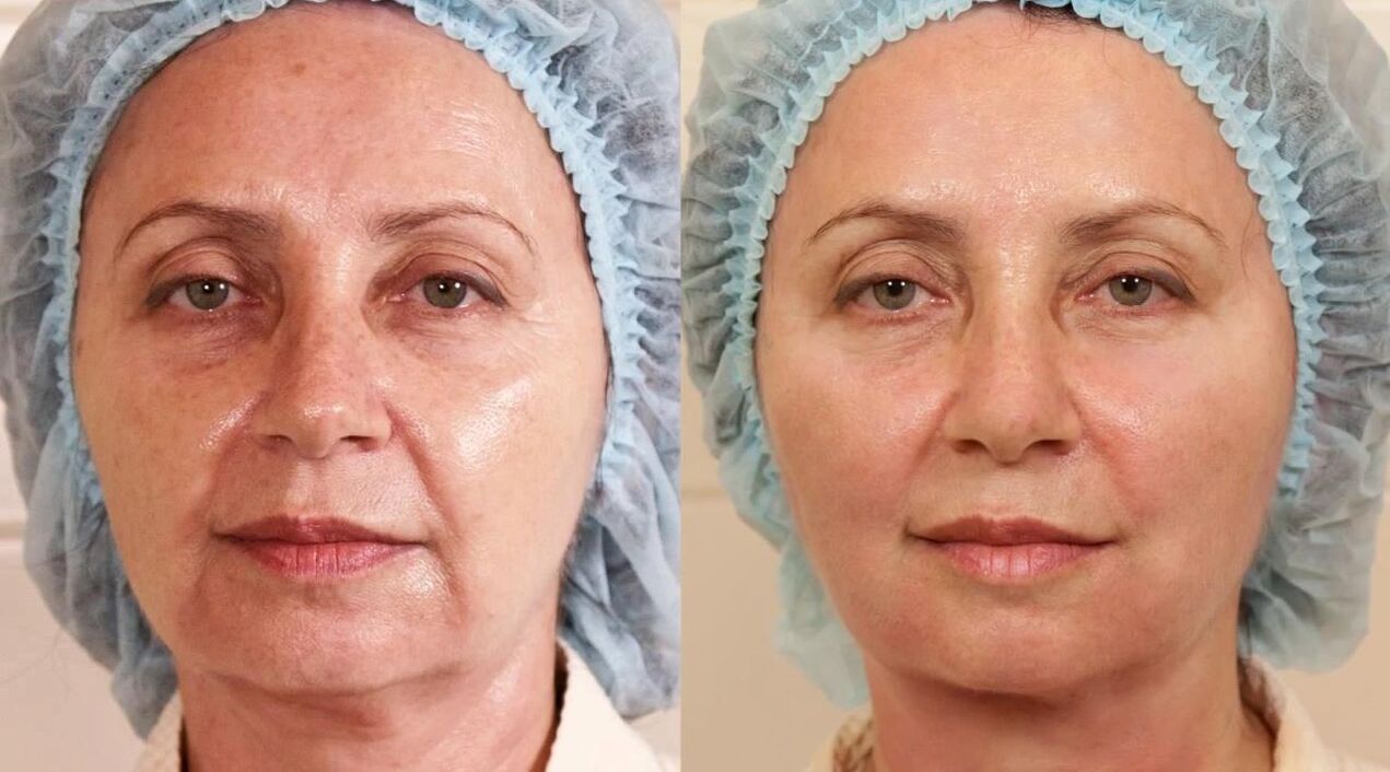Pictures before and after facelift