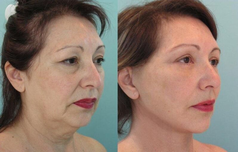 Threading is the result of facial skin rejuvenation