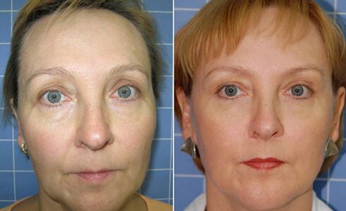 Before and after fractional laser rejuvenation of the face