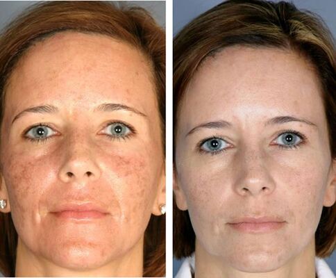 Before and after fractional surface thermolysis