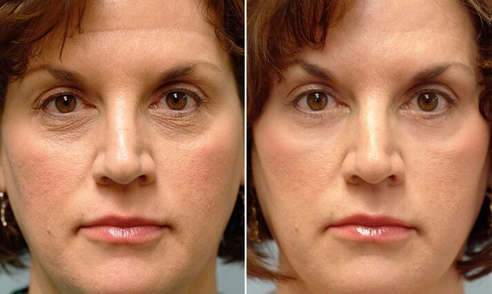 The face before and after laser fractional rejuvenation